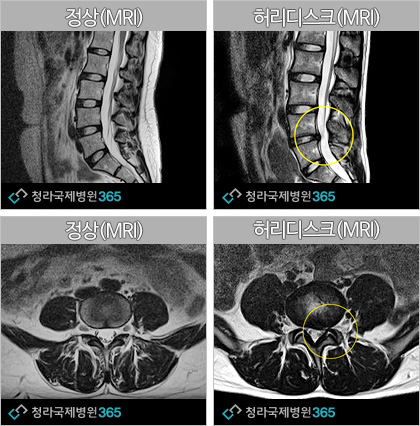 허리디스크 이미지