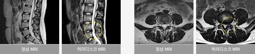 정상 MRI / 허리디스크 MRI
