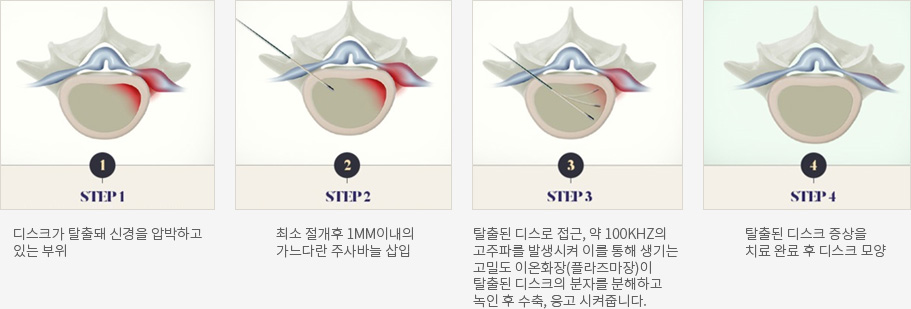 STEP1 디스크가 탈출돼 신경을 압박하고 있는 부위 / STEP2 최소 절개후 1MM이내의 가느다란 주사바늘 삽입 / STEP3 탈출된 디스로 접근, 약 100KHZ의 고주파를 발생시켜 이를 통해 생기는 고밀도 이온화장(플라즈마장)이 탈출된 디스크의 분자를 분해하고 녹인 후 수축, 응고 시켜줍니다. / STEP4 탈출된 디스크 증상을 치료 완료 후 디스크 모양