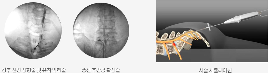 경추 신경 성형술 및 유착 박리술 / 풍선 추간공 확장술 / 시술 시뮬레이션