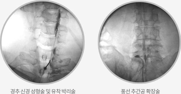 경추 신경 성형술 및 유착 박리술 / 풍선 추간공 확장술