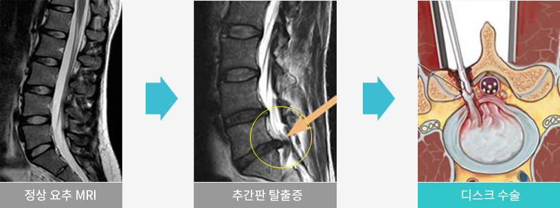 정상 요추 MRI / 추간판 탈출증 / 디스크 수술